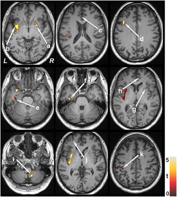 Functional comorbidities and brain tissue changes before and after lung transplant in adults